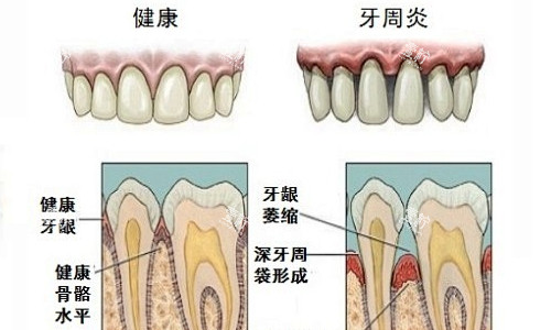 牙周炎情况展示.jpg