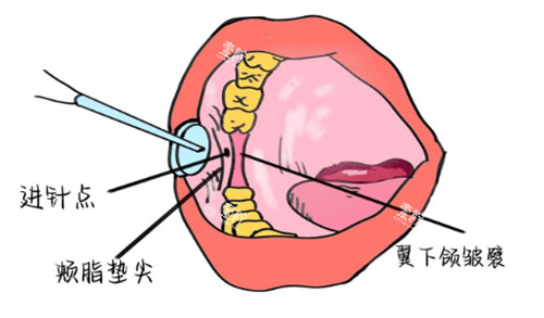 牙周内注射麻醉.jpg