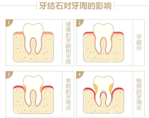 牙结石对牙周的影响.jpg