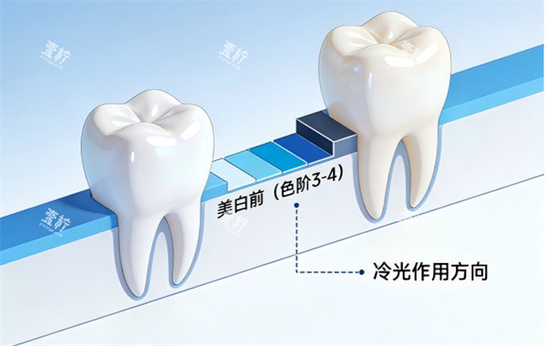 牙齿冷光美白前后治疗示意图.jpg