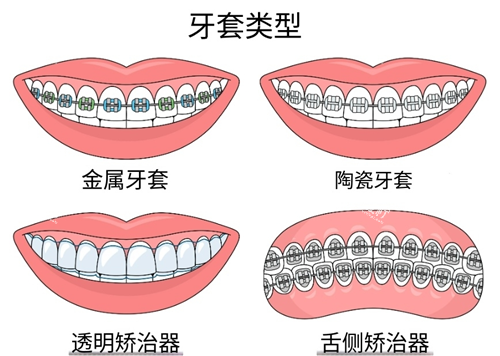 牙齿矫正常见方式.png