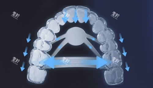 正雅隐形矫正s11牙齿位移变化.png