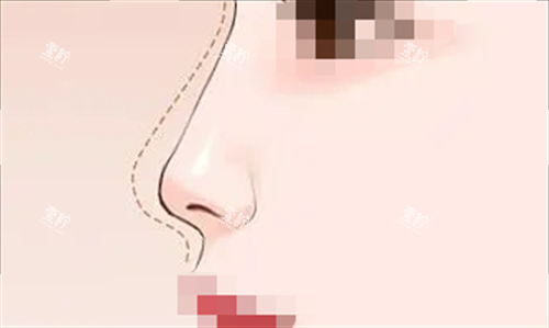 隆鼻预期弧度动画呈现图.png