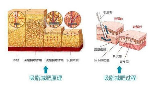 吸脂减肥原理.jpg