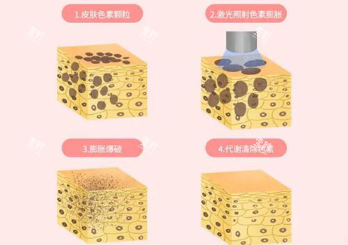 超皮秒皮肤改善原理.jpg 超皮秒皮肤改善原理.jpg