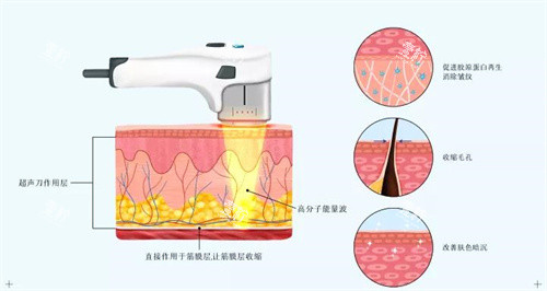 超声炮原理.jpg 超声炮原理.jpg