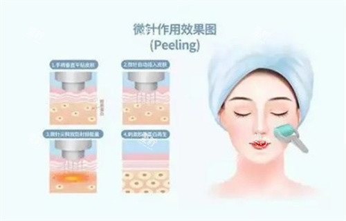 黄金微针作用图.jpg