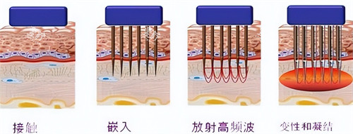 黄金微针操作过程.jpg