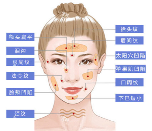 面部脂肪填充部位展示图.jpg