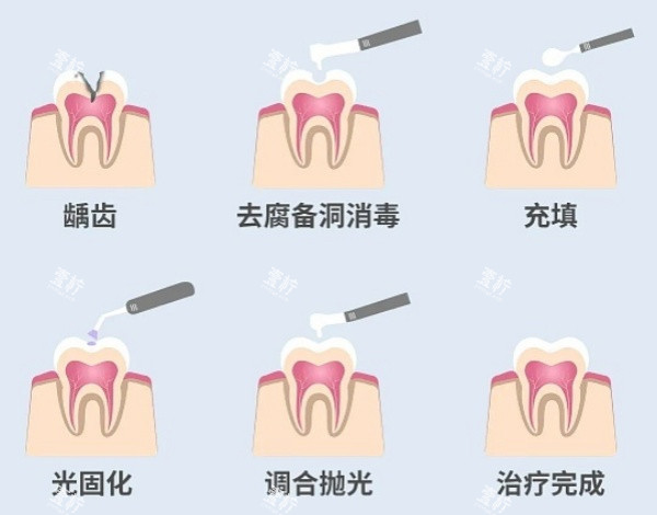 补牙步骤展示图.jpg