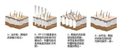 点阵激光治疗原理.jpg