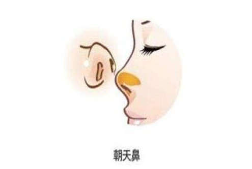 朝天鼻整形手术.jpg