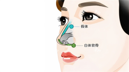 隆鼻卡通示图.jpg 隆鼻卡通示图.jpg