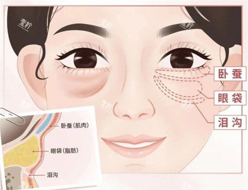 眼袋位置卡通图.jpg