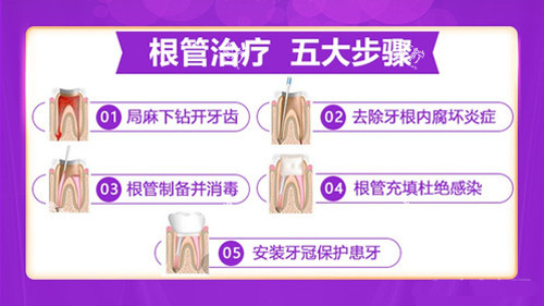 根管治疗的步骤.jpg