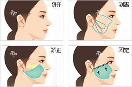 面部耳际小切口拉皮示意图.jpg
