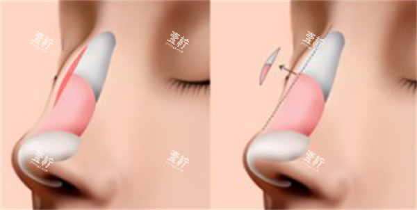 韩国隆鼻前后图片.jpg 韩国隆鼻前后图片.jpg