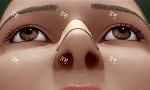 隆鼻卡通图.jpg 隆鼻卡通图.jpg