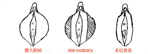 小阴唇肥大直接切除法演示动画图.jpg 小阴唇肥大直接切除法演示动画图.jpg