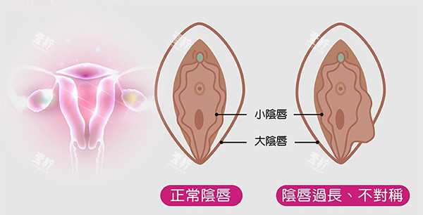 阴唇不对称改善照片.jpg 阴唇不对称改善照片.jpg