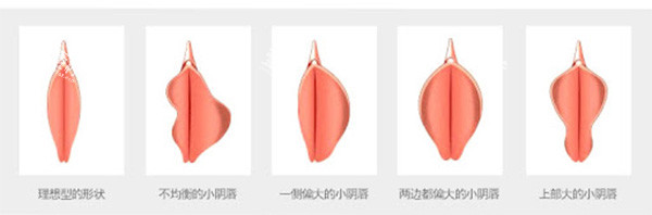 不同阴唇形状情况照片.jpg 不同阴唇形状情况照片.jpg