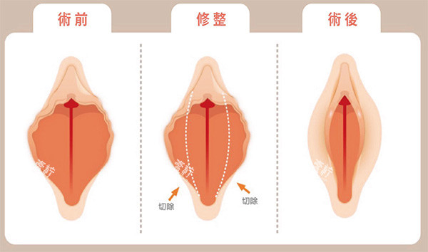外阴唇切除术前术后.jpg 外阴唇切除术前术后.jpg