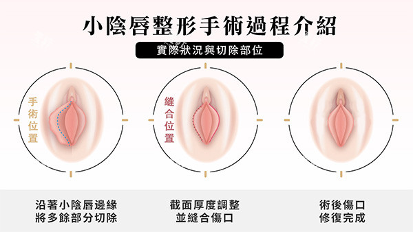 阴唇一边长一边短改善照片.jpg 阴唇一边长一边短改善照片.jpg