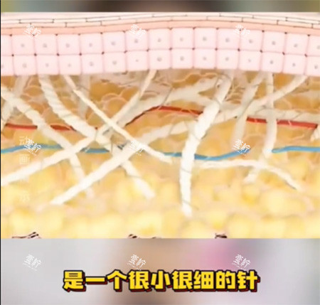 私密紧致针好不好.jpg 私密紧致针好不好.jpg