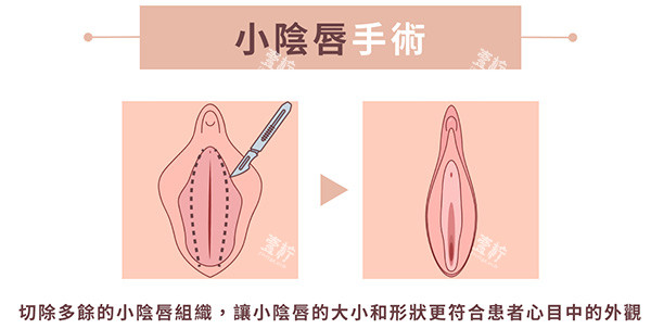 小阴唇整形手术前后照片.jpg 小阴唇整形手术前后照片.jpg