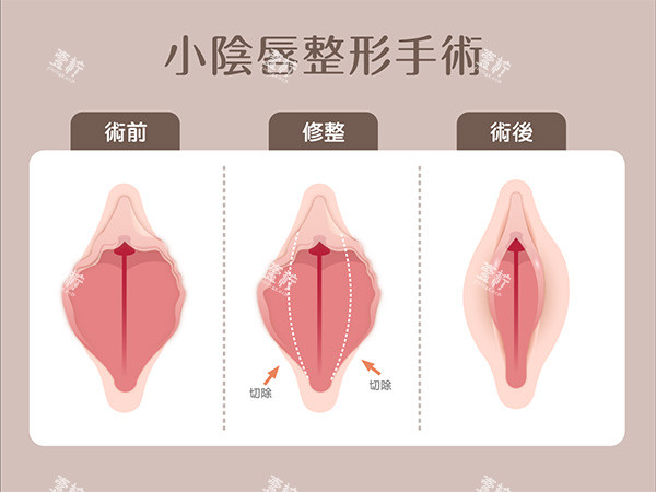 小阴唇整形手术.jpg 小阴唇整形手术.jpg