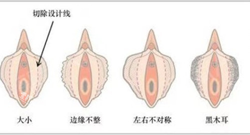 女性私密阴唇整形示意图.jpg 女性私密阴唇整形示意图.jpg