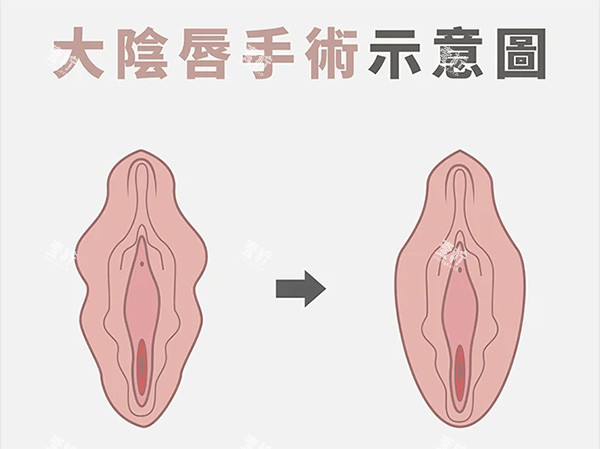 大阴唇整形前后照片.jpg 大阴唇整形前后照片.jpg