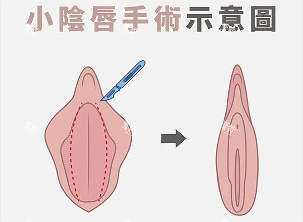 小阴唇整形前后对比.jpg 小阴唇整形前后对比.jpg