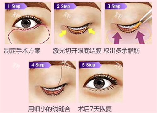 去眼袋手术过程.jpg