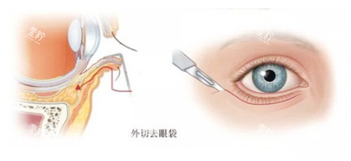 去眼袋切口图示.jpg