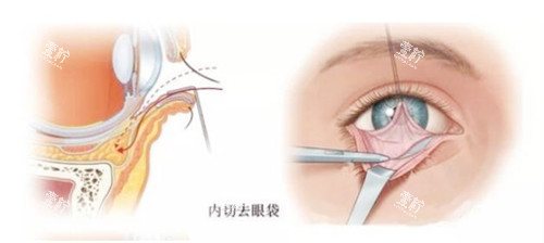 去眼袋手术图示.jpg