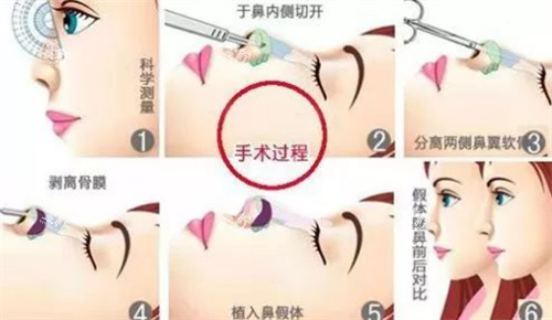 隆鼻过程图解.jpg
