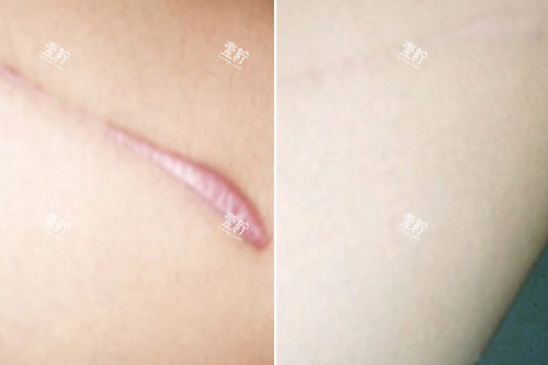 增生疤痕修复对比图.jpg 增生疤痕修复对比图.jpg