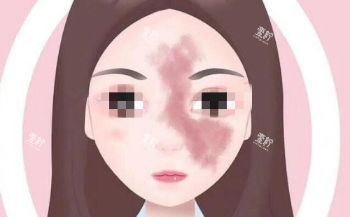 面部胎记示意图.jpg 面部胎记示意图.jpg