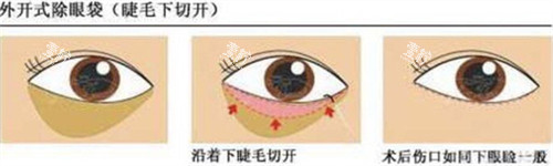 外切法祛眼袋手术步骤.jpg 外切法祛眼袋手术步骤.jpg