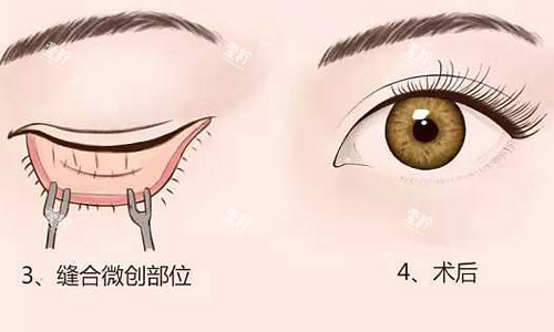 内切祛眼袋展示图.jpg 内切祛眼袋展示图.jpg