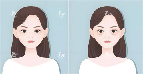 祛眼袋手术前后对比.jpg 祛眼袋手术前后对比.jpg
