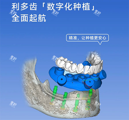 利多齿种植牙怎么样.jpg