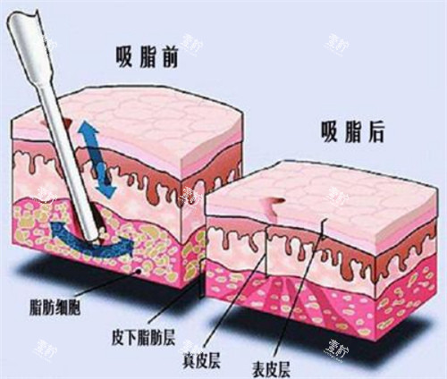 吸脂手术前后对比动画图示.jpg
