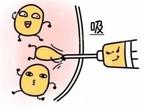 吸脂手术动画.png