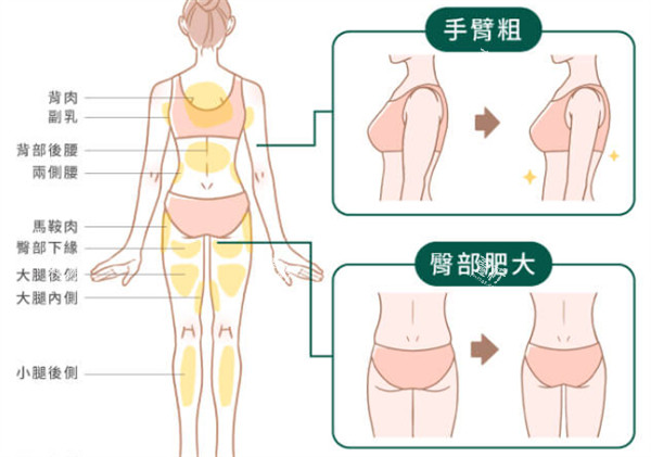 吸脂部位解析.jpg