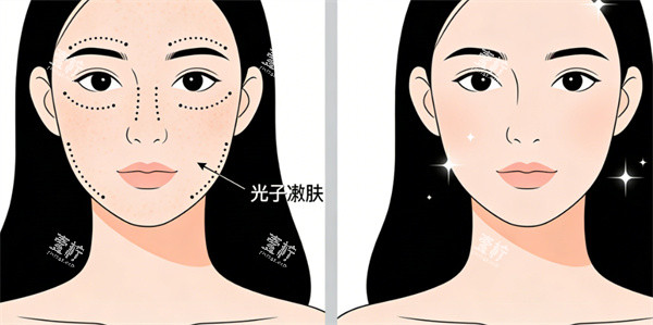 光子嫩肤操作前后对比示意图.jpg