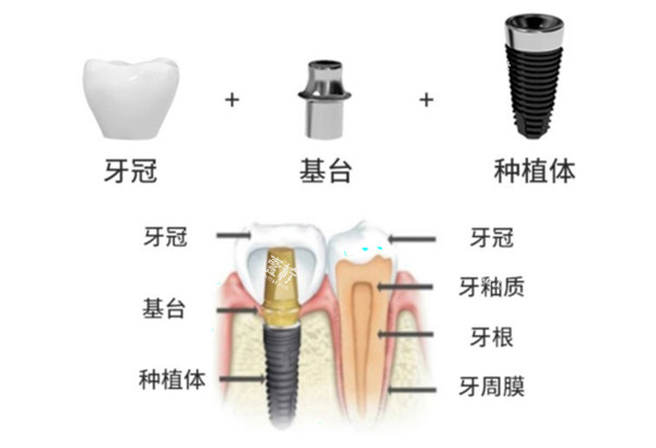 威高种植牙手术过程示意图.jpg