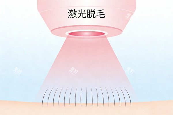 激光脱毛卡通图展示.jpg 激光脱毛卡通图展示.jpg