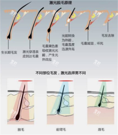 激光脱毛前后对比.jpg 激光脱毛前后对比.jpg
